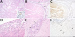 Histopathology and immunohistochemistry of lesions in a cat and rat infected with highly pathogenic avian influenza A(H5N1) virus during outbreak in backyard poultry, United States, 2025. The cat and rat were found dead on a farm in Illinois where the outbreak occurred. A–C) Cat lung (A) and brain (B, C) tissue samples showing substantial histopathology lesions likely related to HPAIV infection. A) Hematoxylin and eosin (H&E) stain of lung tissue shows bronchointerstitial pneumonia; original magnification ×10. Inset shows immunohistochemical (IHC) stain of lung demonstrates light influenza immunoreactivity in distal airway epithelium (arrow). Scale bar indicates 20 µm. B) H&E stain of brain tissue shows nonsuppurative meningoencephalitis (arrows). Scale bar indicates 100 µm. C) IHC stain of brain shows influenza immunoreactivity in cerebrocortical glial cells and neurons. Scale bar indicates 100 µm. D–F) Rat lung (D) and brain (E, F) tissue samples. D) H&E stain of rat lung tissue shows background alveolitis. Original magnification ×20. E) H&E stain of brain tissue shows nonsuppurative periventricular encephalitis (arrows). Scale bar indicates 50 µm. F) IHC of brain tissue shows influenza immunoreactivity in few periventricular neurons (arrows). Scale bar indicates 50 µm.