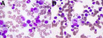 Bone marrow morphology in samples from a 79-year-old man with scrub typhus and myelodysplastic syndrome, Shandong Province, China, 2025. A) High-power view showing a macrophage with abundant cytoplasm filled with fine eosinophilic granules (arrow), morphologically resembling the typhoid cells classically described in Salmonella enterica serovar Typhi bone marrow infection. B) A macrophage exhibiting phagocytosis of a neutrophil (arrow). The findings were initially interpreted as evidence of typhoid fever but were ultimately attributed to Orientia tsutsugamushi infection, confirmed by targeted next-generation sequencing. (\Wright-Giemsa stains; original magnification ×1,000.