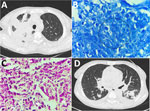 Histopathologic and radiologic findings in renal transplant recipient with disseminated trimethoprim/sulfamethoxazole–resistant nocardiosis, India. A) High-resolution computed tomography of the chest before treatment, showing right-upper-lobe consolidation with adjacent passive atelectasis and a left pleural effusion. B) Lung biopsy, Fite stained, showing weakly acid-fast, branching, beaded filamentous bacteria (circle). Original magnification ×1,000. C) Lung biopsy, hematoxylin and eosin stained, showing suppurative inflammation (arrows). Original magnification ×400. D) High-resolution computed tomography of the chest 6 months after treatment, showing resolution of the consolidation with residual pulmonary fibrosis.