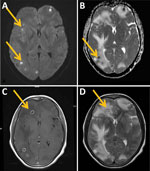 Brain magnetic resonance imaging in renal transplant recipient with disseminated trimethoprim/sulfamethoxazole–resistant nocardiosis, India. A) Diffusion-weighted image showing multiple foci of central diffusion restriction (arrows). B) Apparent diffusion coefficient map showing corresponding signal change (arrow). C) Axial T1-weighted postgadolinium image showing ring-enhancing supratentorial lesions (arrow). D) Axial T2-weighted image showing lesions with central hyperintensity, a hypointense rim, and perilesional edema (arrow).