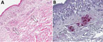 Immunohistochemistry and skin pathology from study of fatal Rickettsia parkeri rickettsiosis in immunocompromised pediatric patient, Georgia, USA, 2025. A) Punch biopsy specimen obtained from a rash lesion of the lower extremity of the patient demonstrating mild superficial dermal edema and small perivascular hemorrhages (arrows) without distinct inflammatory cell infiltrates. Hematoxylin and eosin stain; original magnification ×62.5. B) Immunohistochemical staining using an antibody reactive with spotted fever group Rickettsia spp., including Rickettsia parkeri, shows abundant staining of rickettsiae and rickettsial antigens in the lumens of the vessels, with invasion through the endothelium into the surrounding tissue (arrows). Immunoalkaline phosphatase with naphthol fast red and hematoxylin counterstain; original magnification ×62.5.