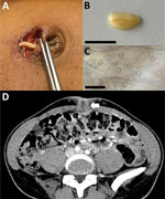 Armillifer armillatus parasite imaging in case of human infection mimicking strangulated umbilical hernia, France, 2026. A) Perioperative macroscopic photograph of the umbilical subcutaneous cyst and parasite. B) Gross appearance of the extracted nymph indicating its cylindrical shape and cuticular annulations. Scale bar = 1 cm. C) Microscopic view of the body wall showing cuticular openings. Scale bar = 50 μm. D) Thoracoabdominal computed tomography showing a 15-mm subcutaneous cyst (arrow) with surrounding fat stranding and no visible C-shaped calcifications.